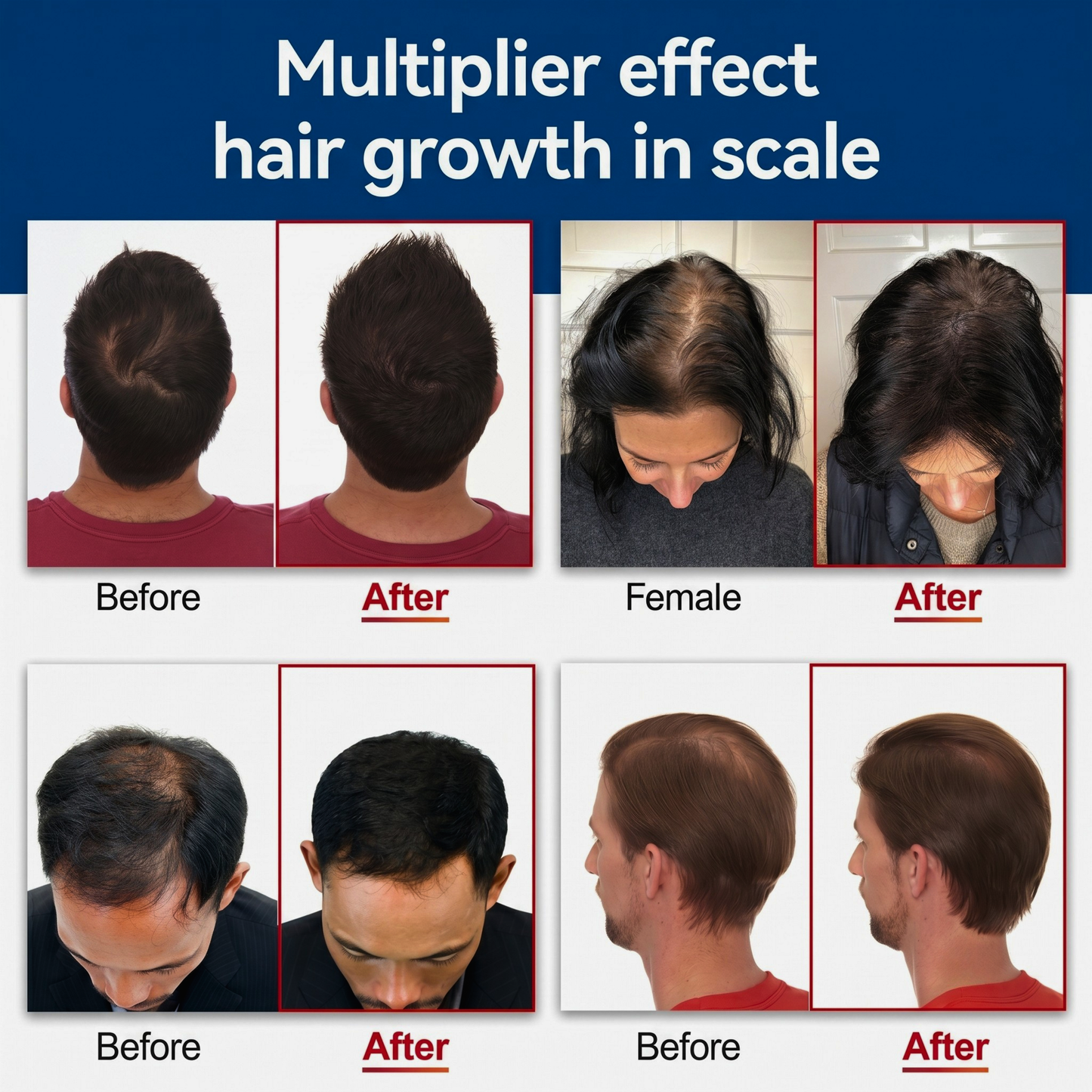 Folivia X Pro™ – FDA-Cleared 162-Laser Hair Growth System